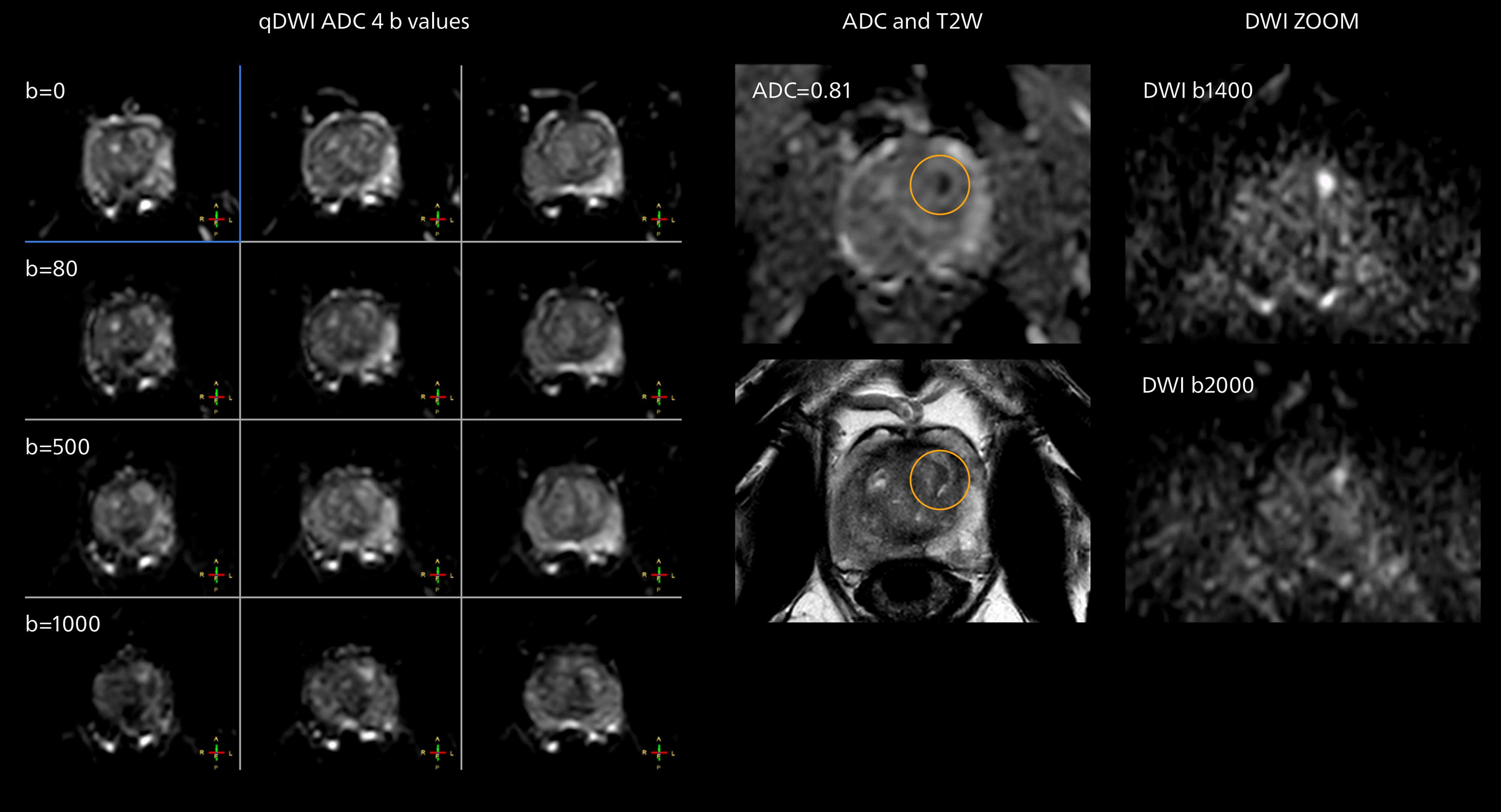 Prostate mri