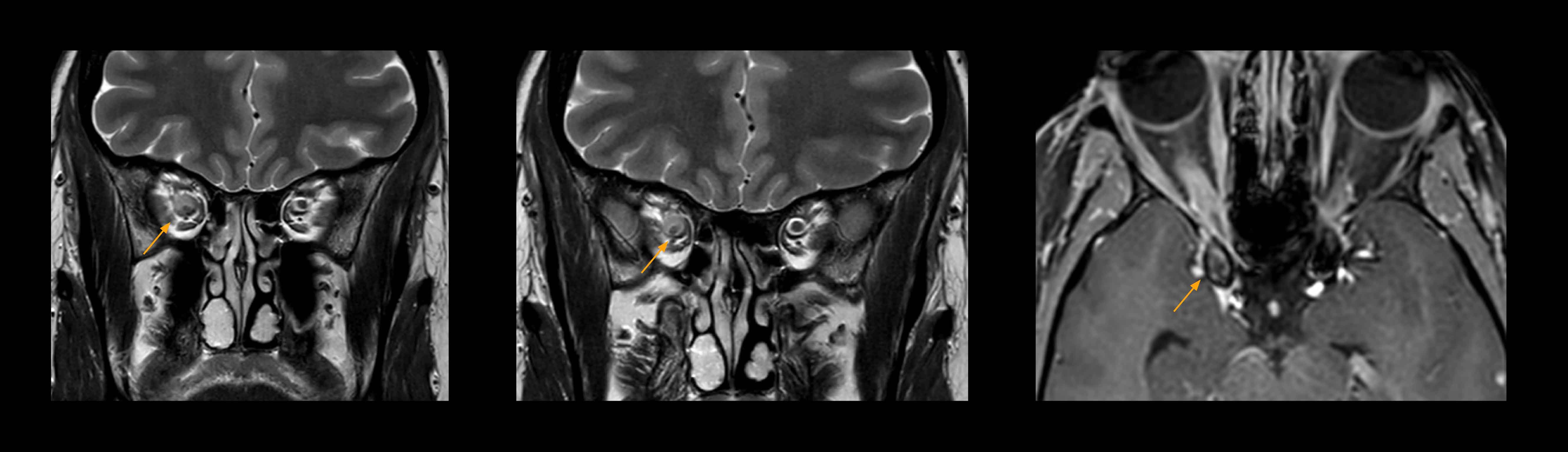 Optic nerve mri