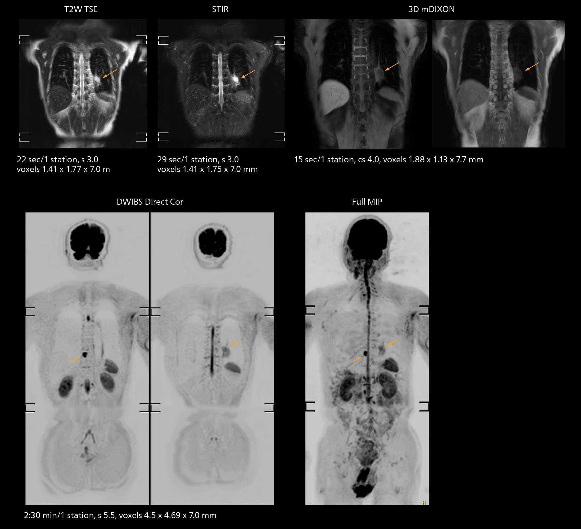 Whole body mri
